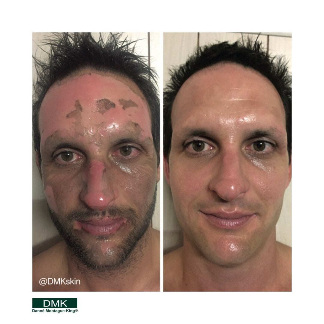 Before and after side-by-side comparison photos of a man's face showing skin treatment results, with visible redness and blemishes on the left and clearer skin on the right using DMK Beta Gel