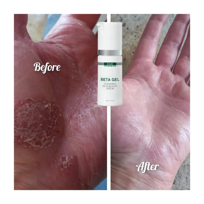 A split-screen comparison showing a hand with dry, cracked skin labeled 'Before' on the left and smooth, healed skin labeled 'After' on the right, with a small white bottle of DMK Beta Gel centered between the two images.