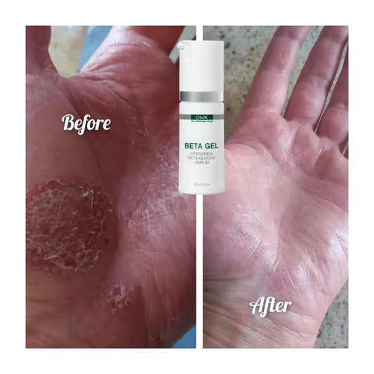 A split-screen comparison showing a hand with dry, cracked skin labeled 'Before' on the left and smooth, healed skin labeled 'After' on the right, with a small white bottle of DMK Beta Gel centered between the two images.