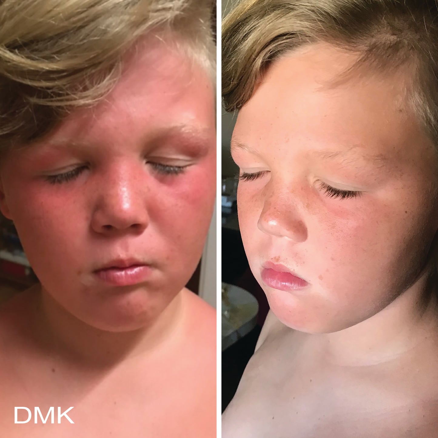 Side-by-side comparison of a young boy's face with sunburn before and clear, calmed skin after, using DMK Beta Gel