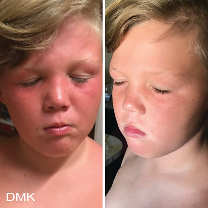 Side-by-side comparison of a young boy's face with sunburn before and clear, calmed skin after, using DMK Beta Gel