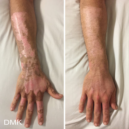 Before and after comparison of a person's arm and hand on a white background, after using DMK Beta Gel