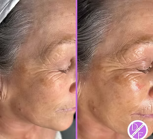 Side-by-side comparison of an elderly person's face with and without dermaplaning exfoliation treatment.