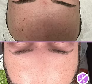 Before and after comparison of a person's face with microneedling treatments.