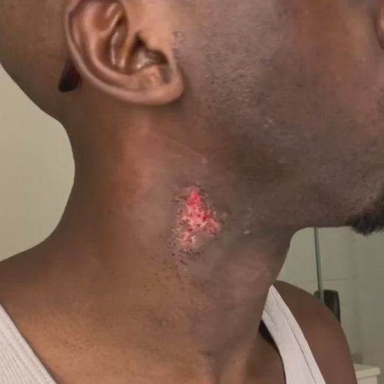 DMK Reel showing the results of using Beta Gel on burns
