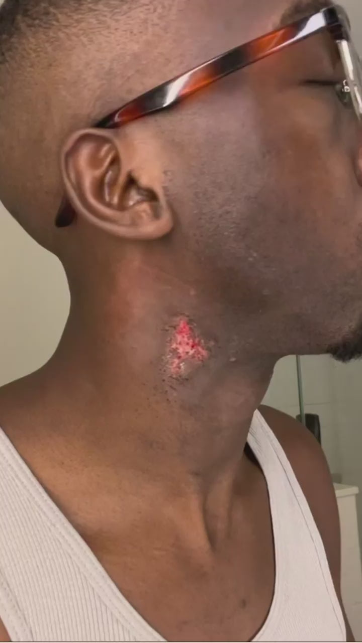 DMK Reel showing the results of using Beta Gel on burns